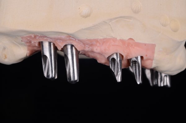 Restauration totale supérieure scellée sur piliers implantaires